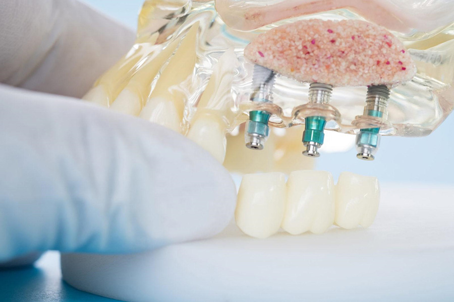 Современная стоматология: что делать, когда сломался зуб?